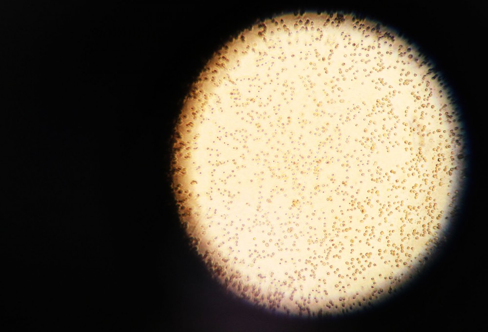 Lung cancer cells are seen through an undergraduate research students microscope. She is testing drugs to kill the cells.